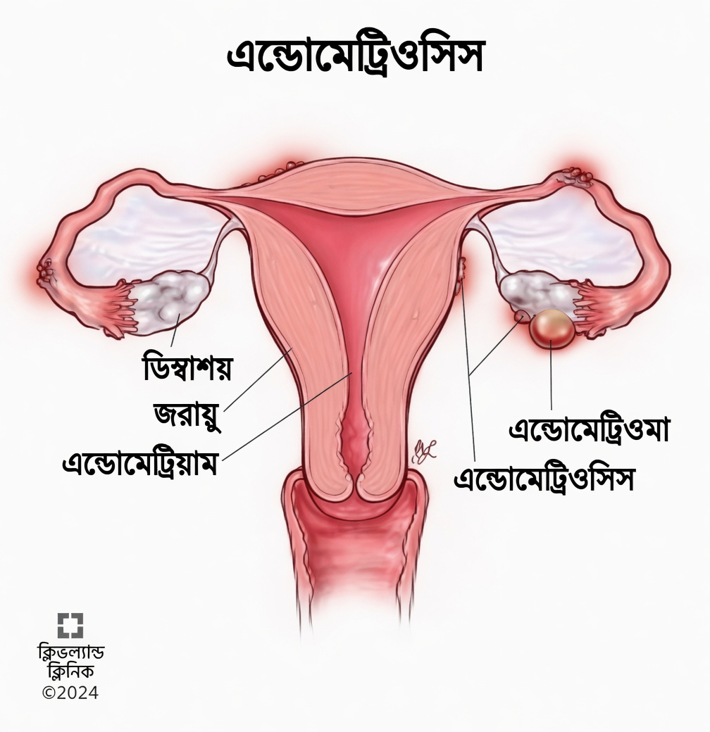 এন্ডোমেট্রিওসিস কী এবং কেন প্রতিটি নারীর এ সম্পর্কে জানা উচিত?