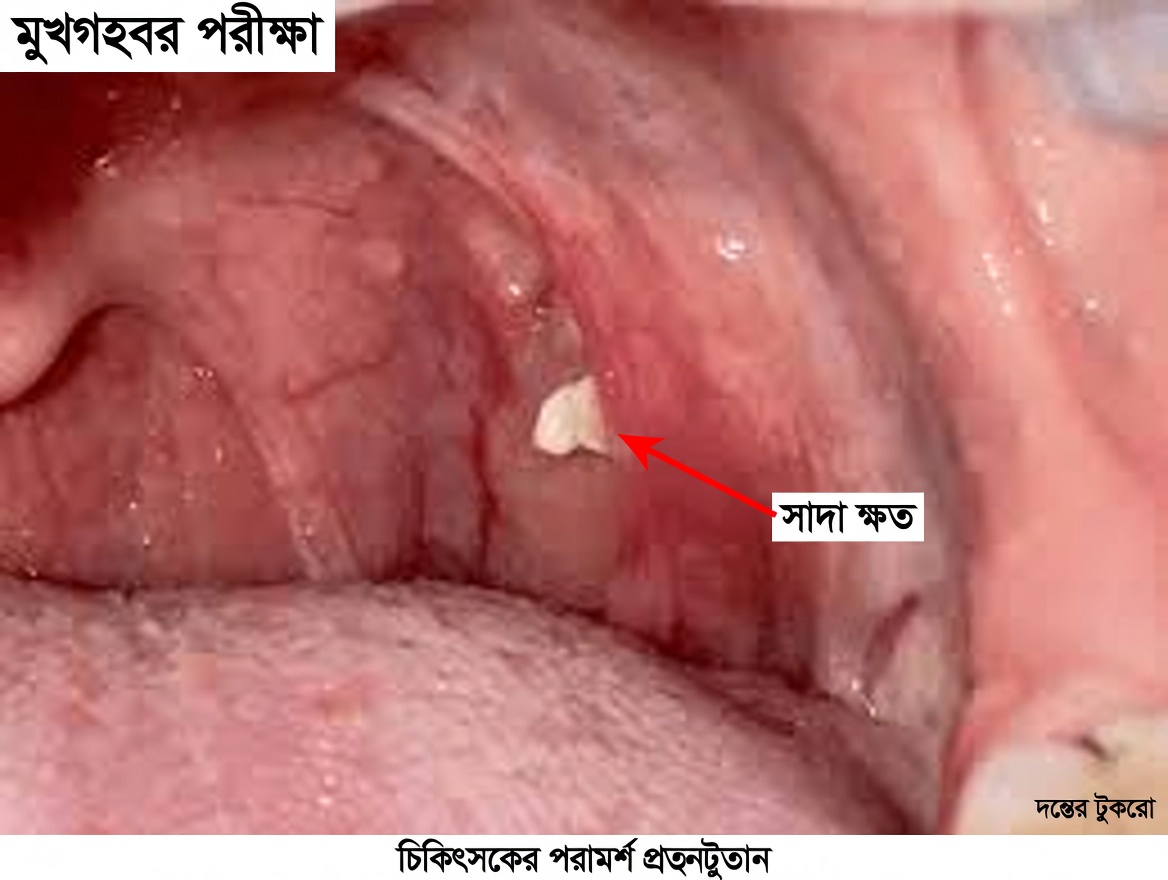 হাঁচির পর আপনার গলা থেকে বেরিয়ে আসা সেই ছোট গাঁটটি কী? টনসিল স্টোন সম্পর্কে জানুন
