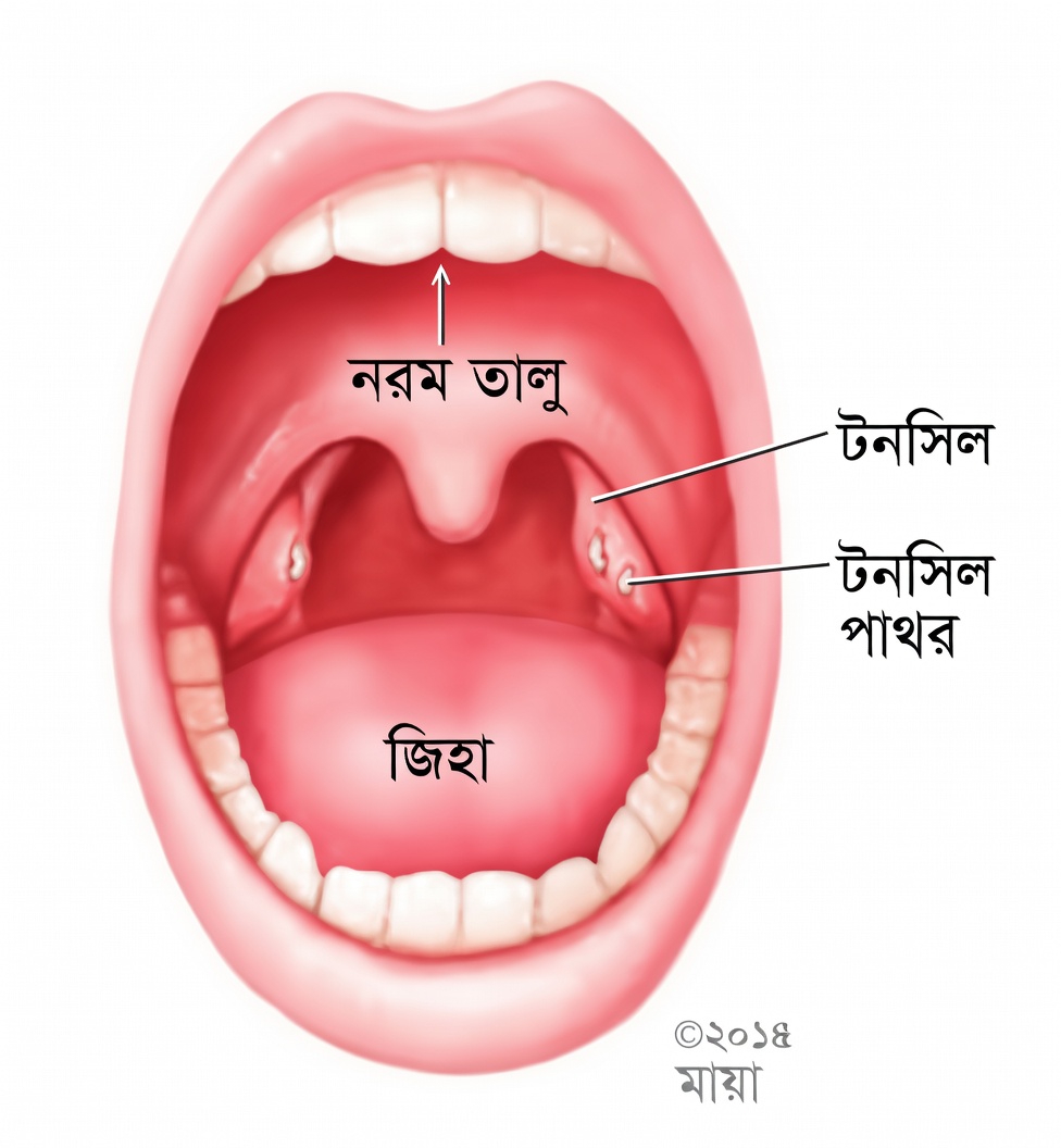 হাঁচির পর আপনার গলা থেকে বেরিয়ে আসা সেই ছোট গাঁটটি কী? টনসিল স্টোন সম্পর্কে জানুন