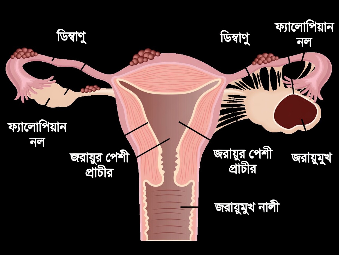 এন্ডোমেট্রিওসিসের সতর্কবার্তা: প্রতিদিনের যে অভ্যাসগুলো আপনার উপেক্ষা করা উচিত নয়