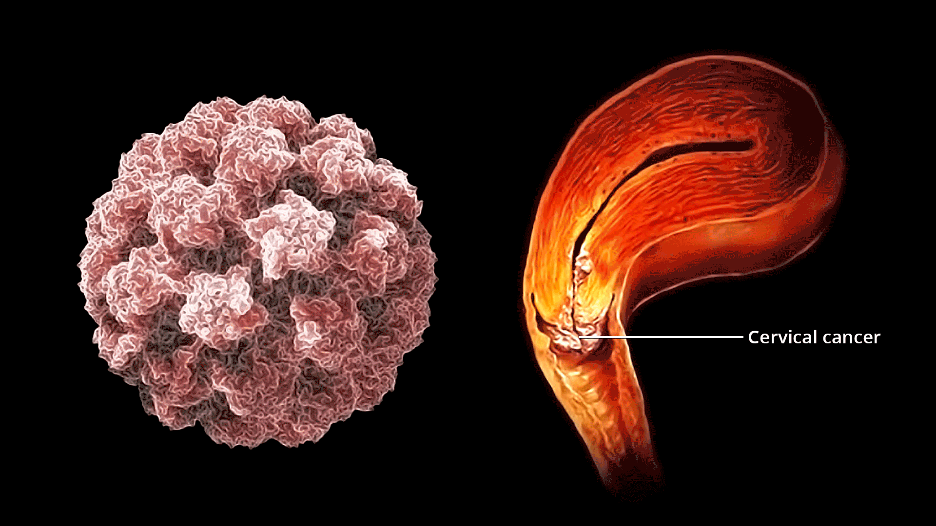 জরায়ুমুখের ক্যান্সারের গুরুতর লক্ষণগুলো যা প্রতিটি নারীর জানা উচিত এবং কখনোই উপেক্ষা করা উচিত নয়