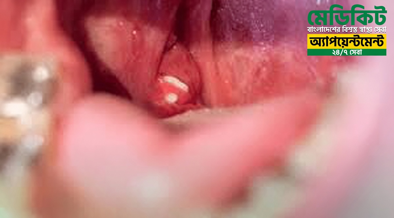 টনসিল স্টোন: এগুলো কী এবং কেন এগুলো আপনার দীর্ঘস্থায়ী মুখের দুর্গন্ধের কারণ হতে পারে