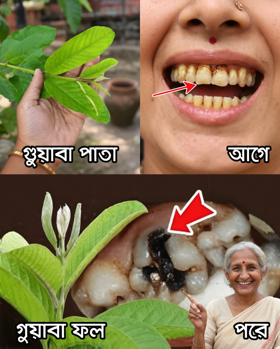 পেয়ারা পাতার সাহায্যে দাঁতের ক্ষয় চিকিৎসার শীর্ষ ৩টি উপায় – সহজ ও সাশ্রয়ী