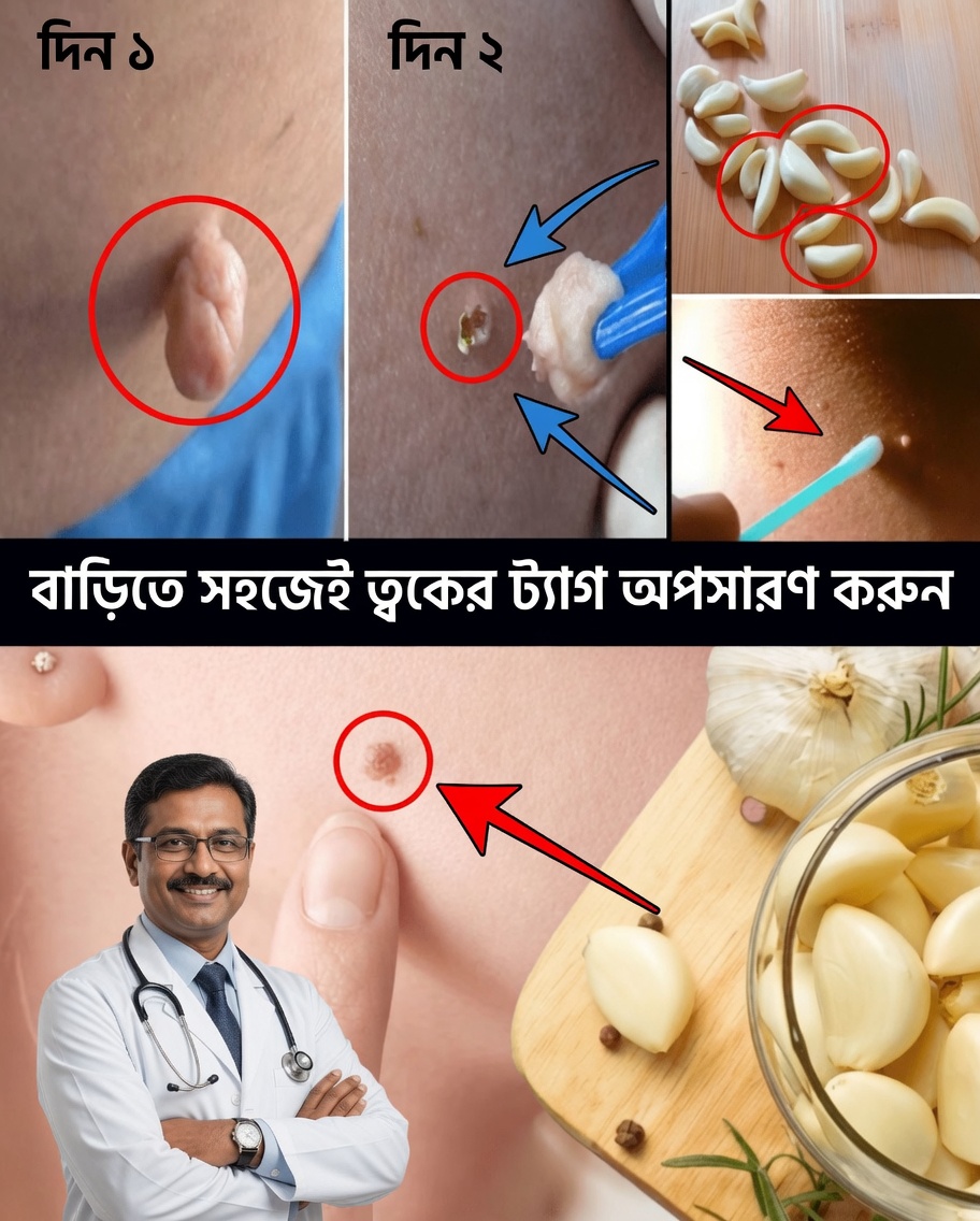 ভ্যাসলিন দিয়ে প্রাকৃতিকভাবে স্কিন ট্যাগ অপসারণের উপায়: সহজ রাতারাতি পদ্ধতি